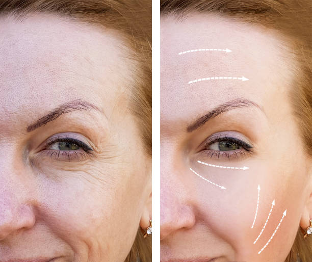 woman wrinkles before and after the procedure
