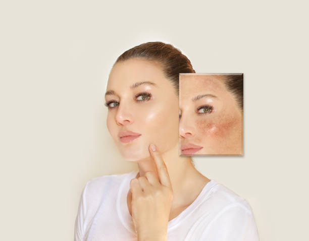 Dark spots, freckles,hyperpigmentation(melasma or chloasma),concept- skin lightening, skin whitening, Skin Brightening