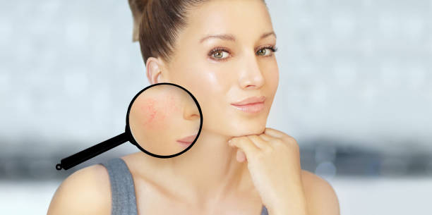 Rosacea ,facial redness.Before and after.